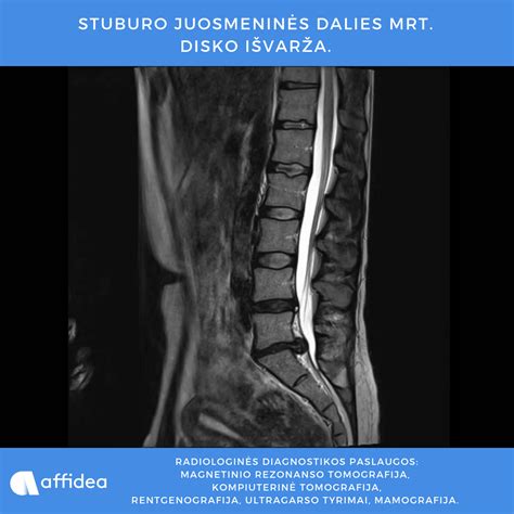 Scheminis stuburo pažeidimo tipų pavaizdavimas