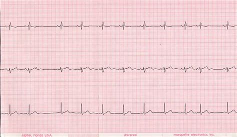 Širdies ekg diagrama