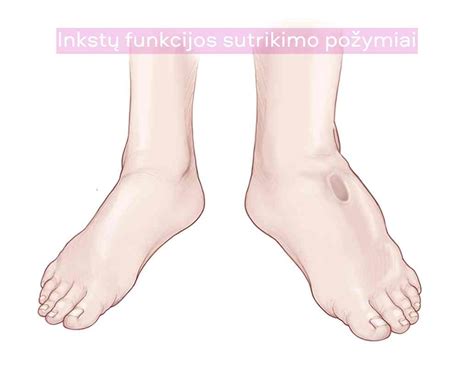 Skysčių nuotėkio požymiai