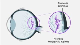 Palyginimas: sveika akis ir akis, serganti neovaskuline amžine geltonosios dėmės degeneracija