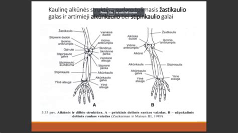 simbolinė rankos lūžio iliustracija