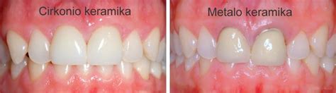 Cirkonio oksido struktūra