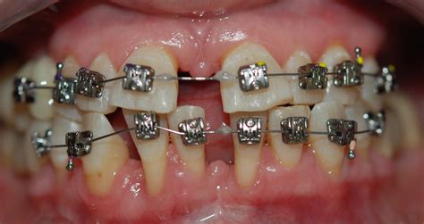 Ortodontinis gydymas: breketai ir tiesintuvai