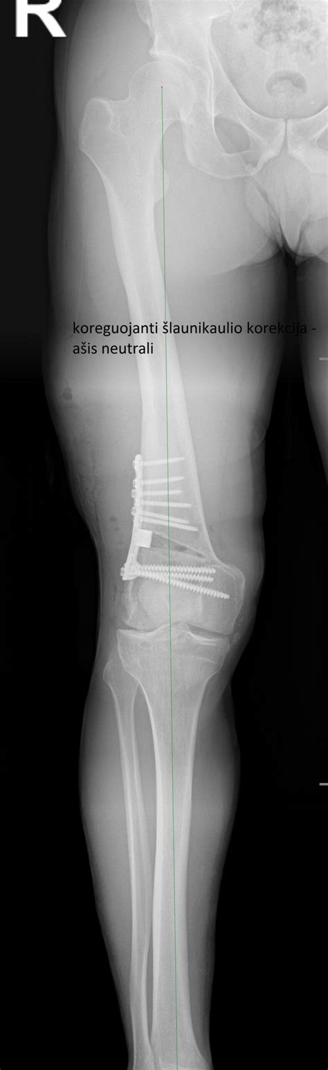 3D modelis, demonstruojantis šlaunikaulio anatomiją ir osteosintezės plokštelės pritaikymą