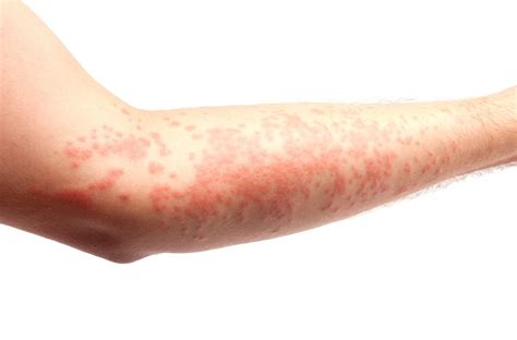 Kontaktinis dermatitas